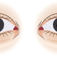 眼睛突出？建议查查甲状腺！