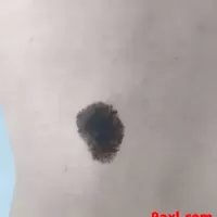 网上看到的身上的痣