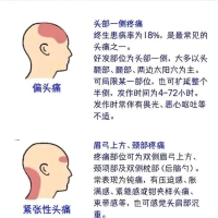 图解不同部位的头痛