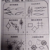 手掌纹理形符病象性质