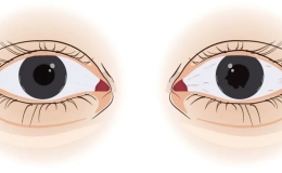 眼睛突出，建议查查甲状腺